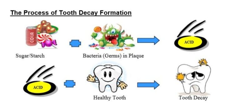 Tooth Decay Chart